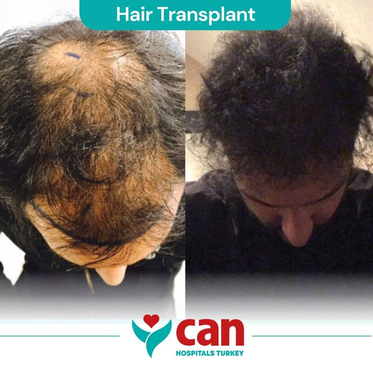 Case 15377 - hair transplant