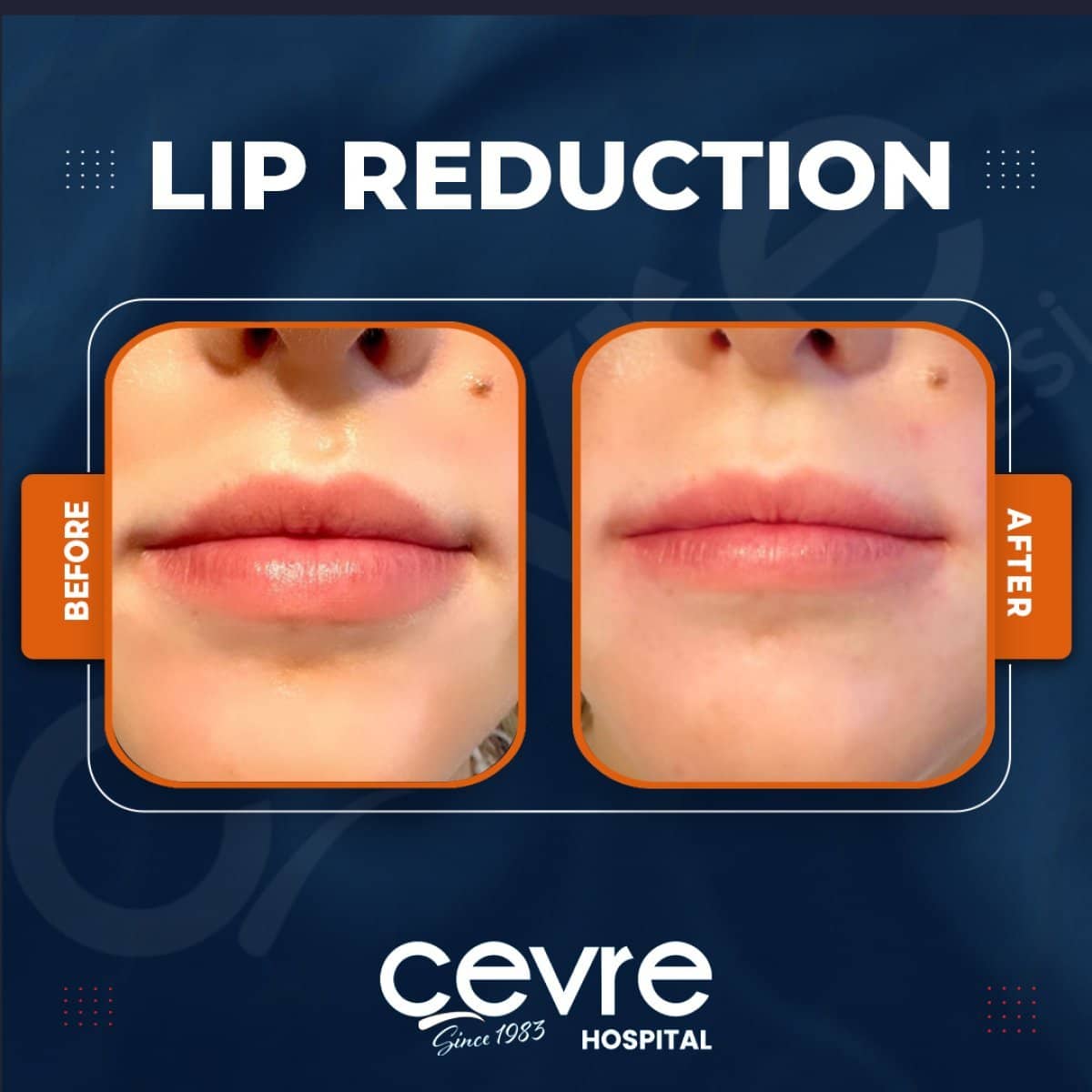 Case 15387 - lip reduction