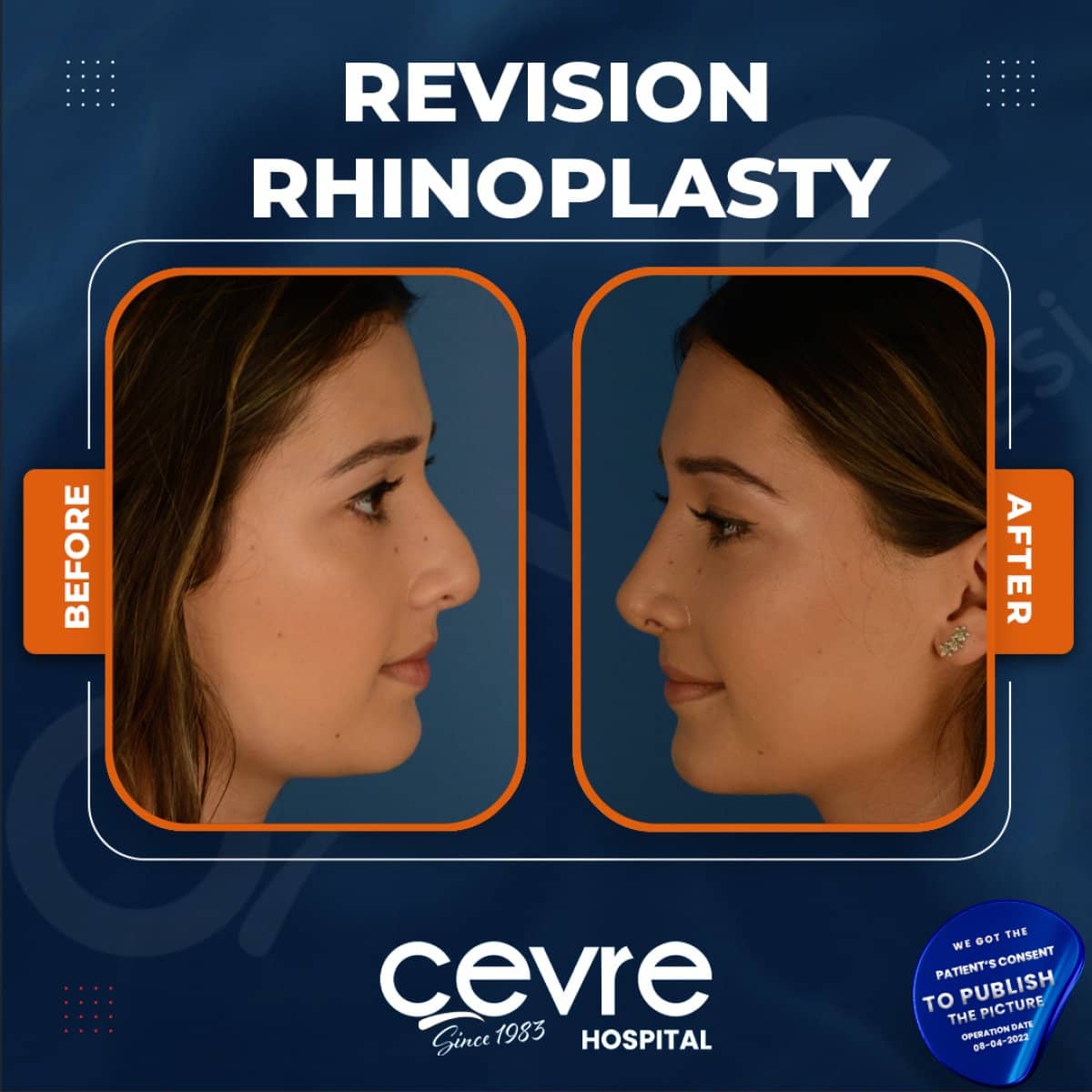 Case 15389 - revision rhinoplasty