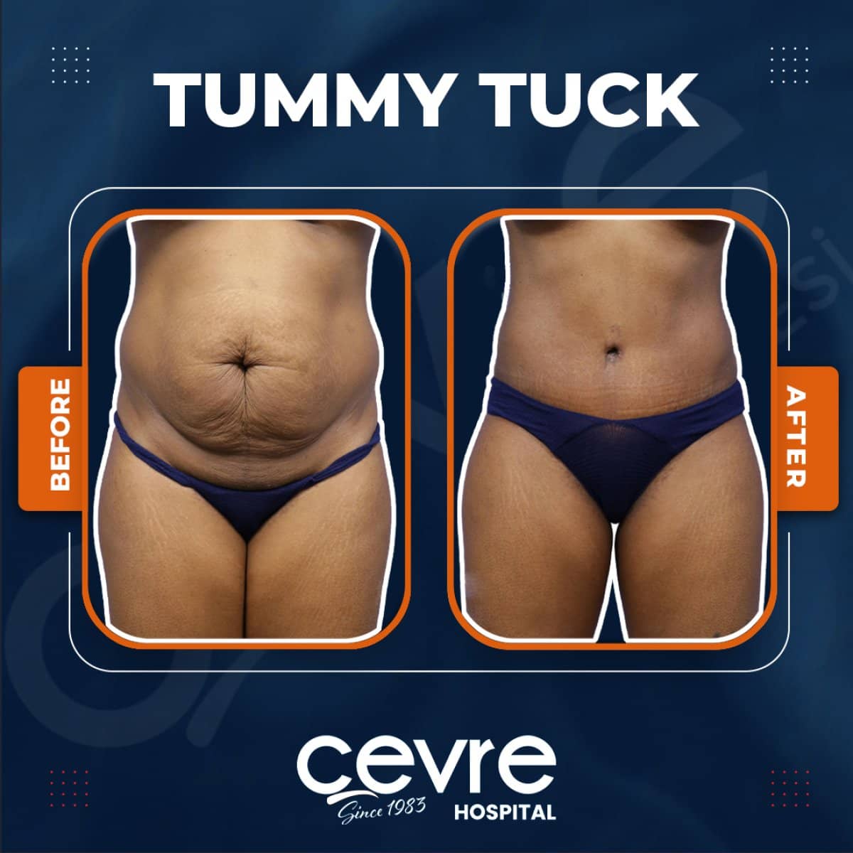 Case 15390 - tummy tuck