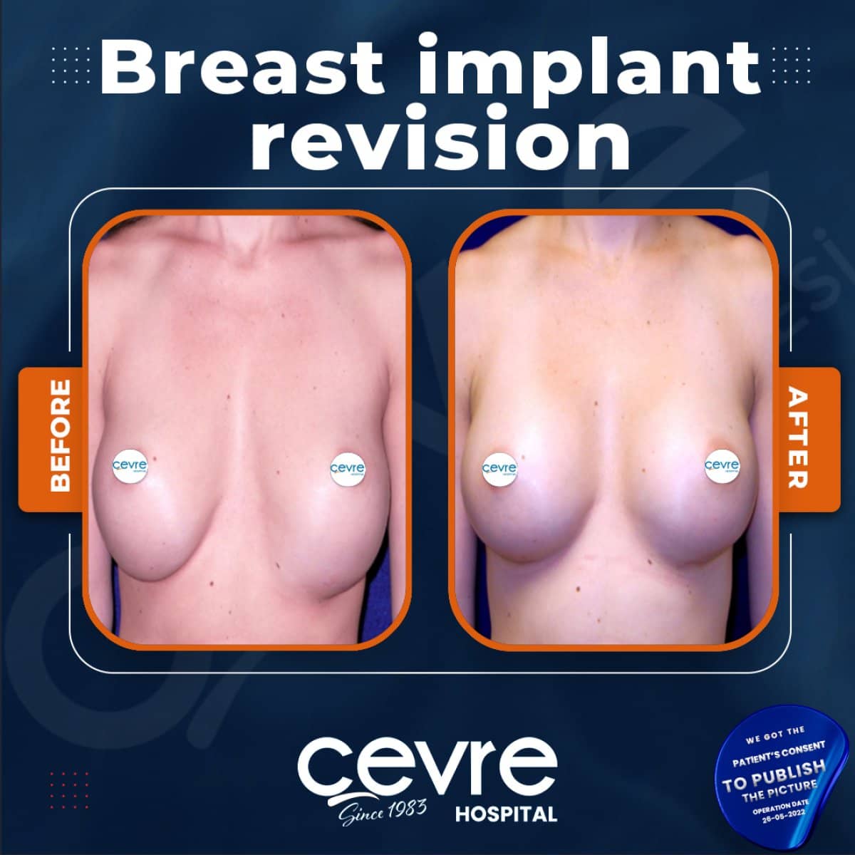 Case 15391 - breast implant revision