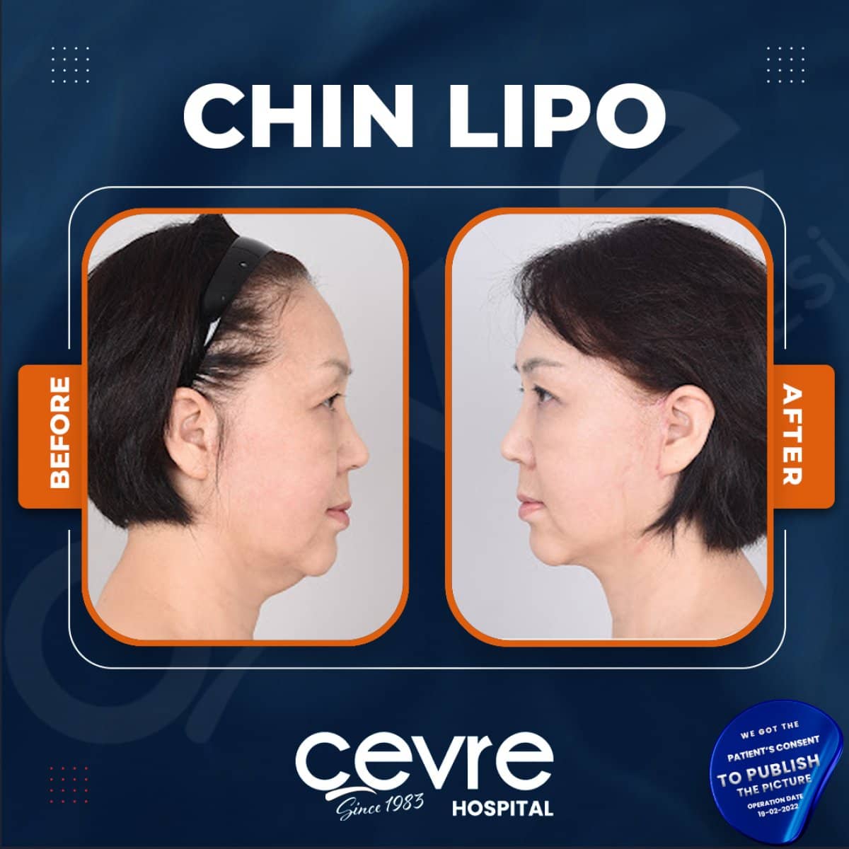 Case 15392 - chin liposuction