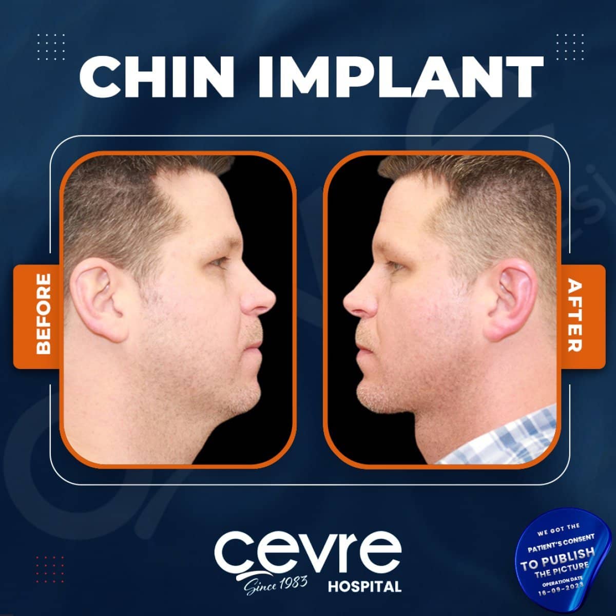 Case 15394 - chin implant