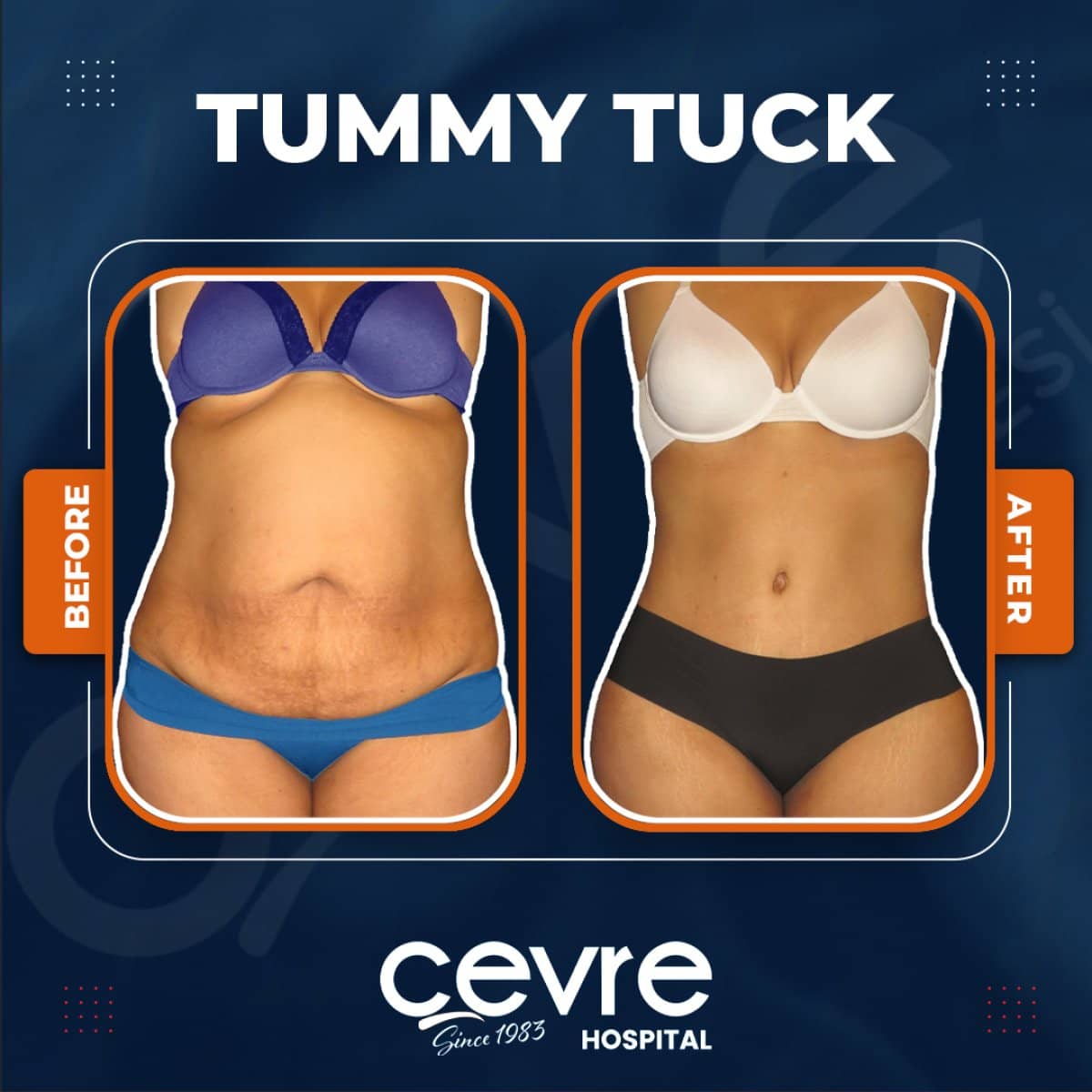 Case 15396 - tummy tuck