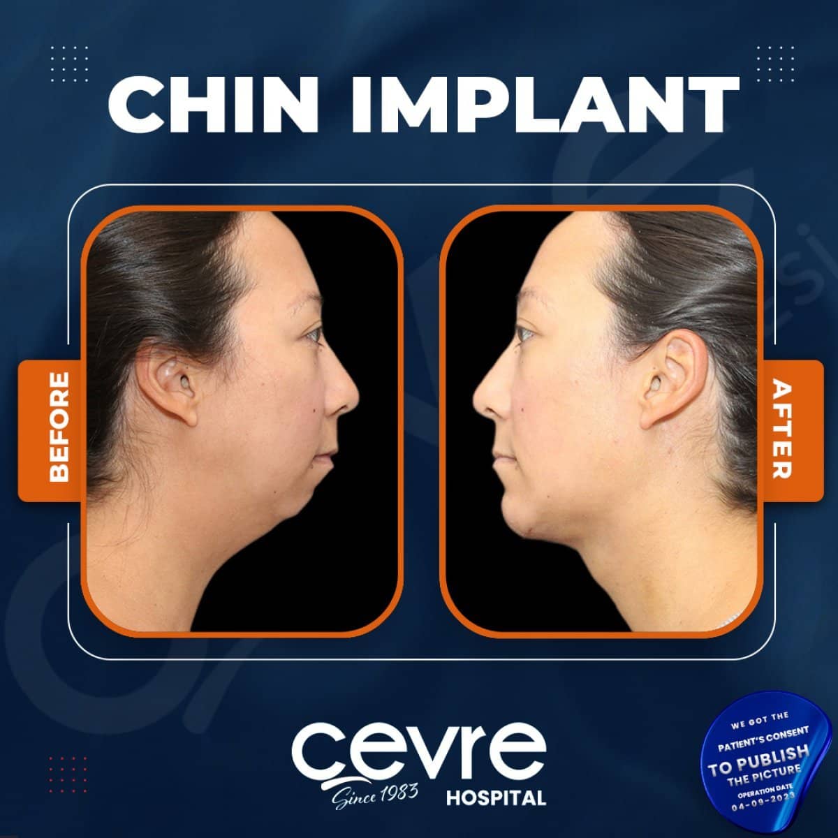Case 15397 - chin implant