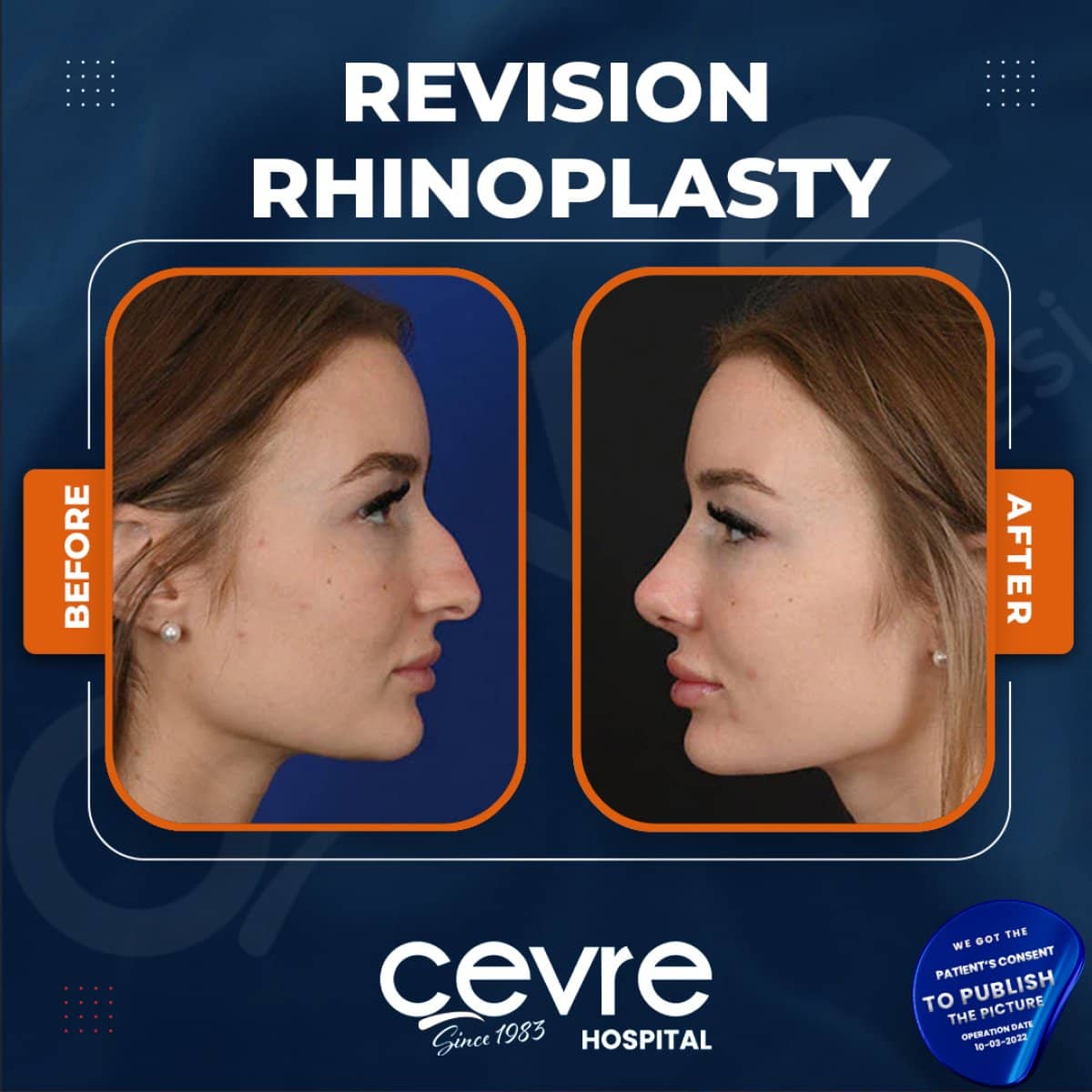 Case 15403 - revision rhinoplasty