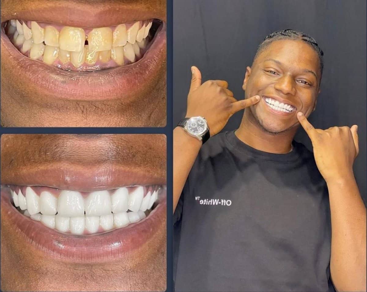 Case 15411 - mini dental implant