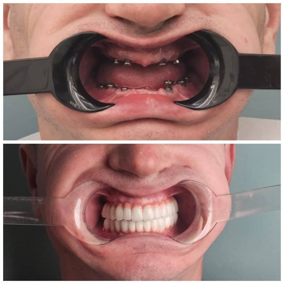 Case 15419 - All-on-6 dental implants