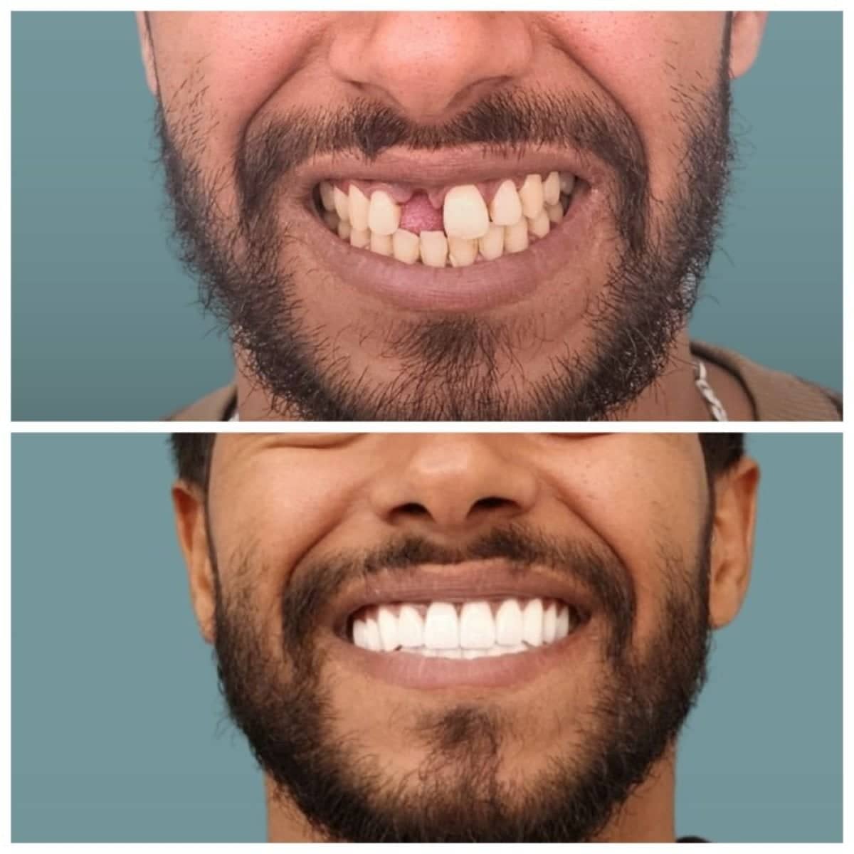Case 15420 - dental implant with crown