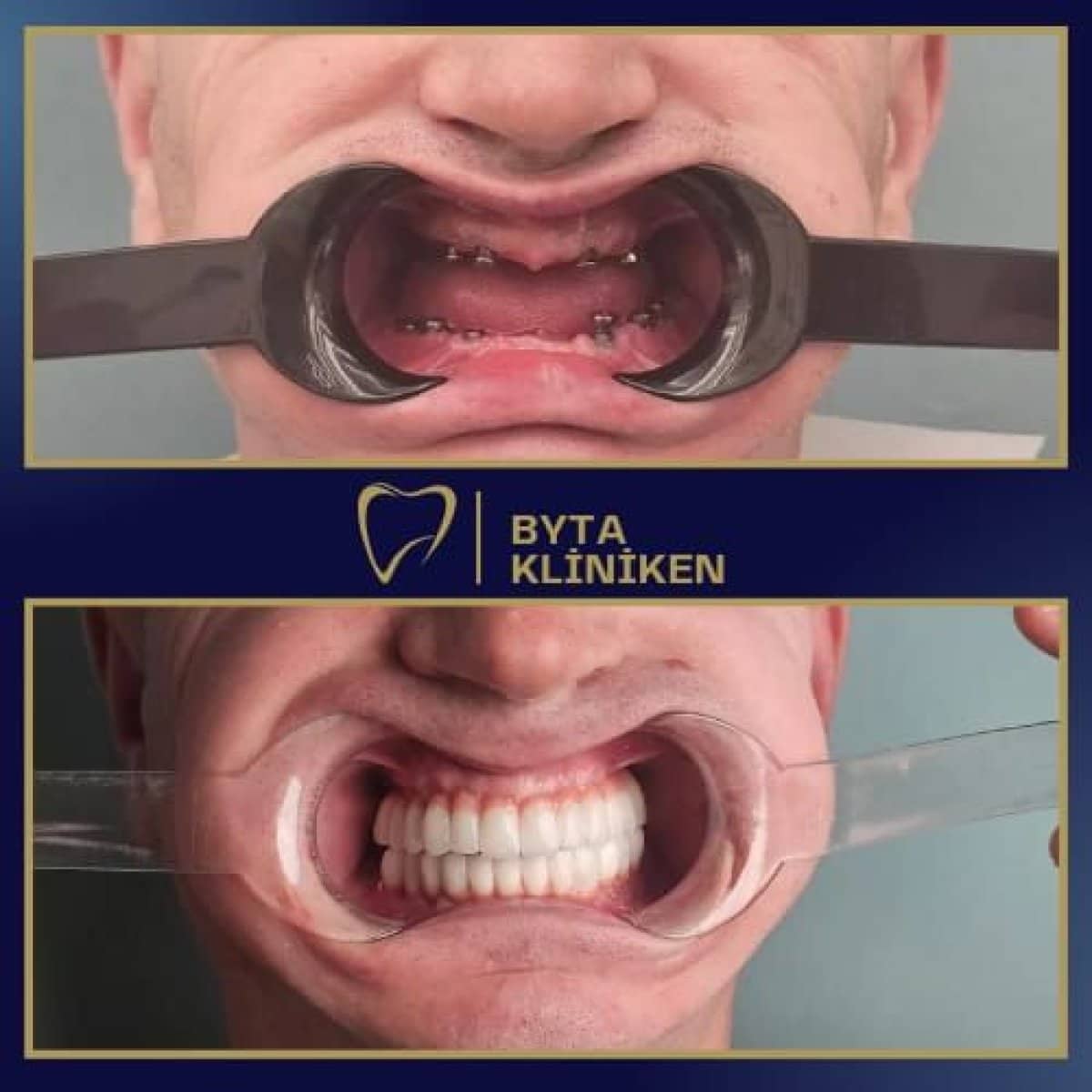 Case 15425 - All-on-4 dental implants