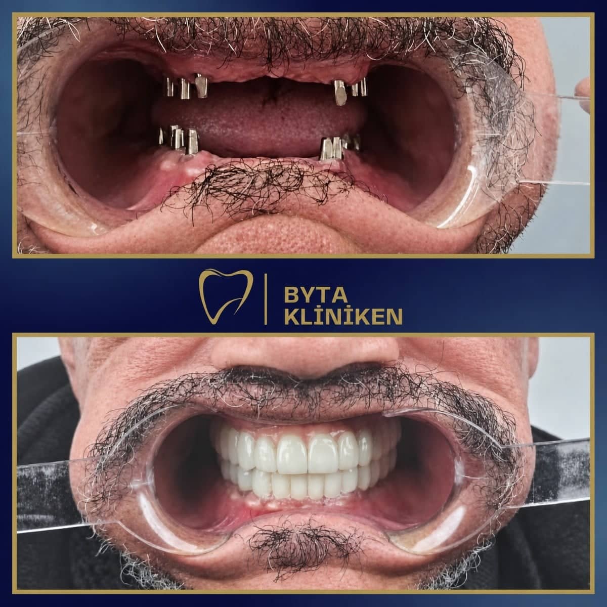 Case 15426 - All-on-4 dental implants