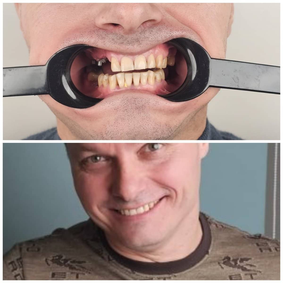 Case 15429 - dental implant