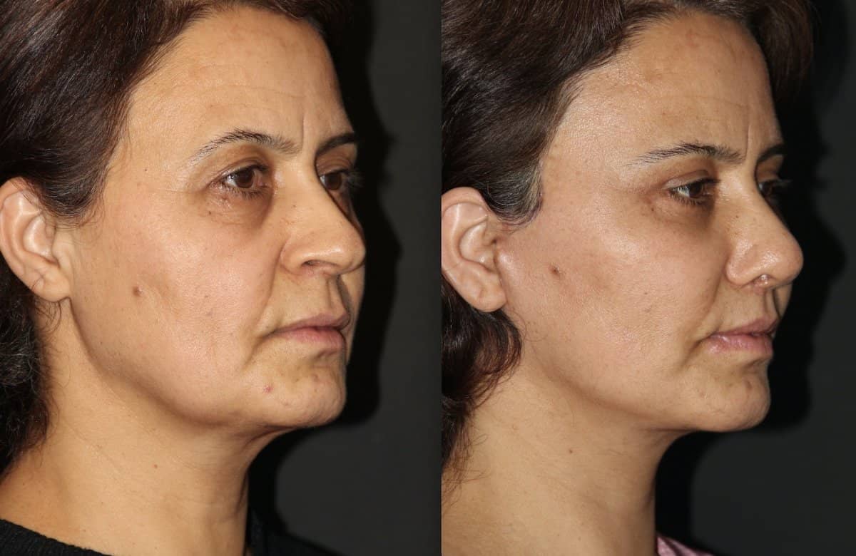 Case 15433 - facelift