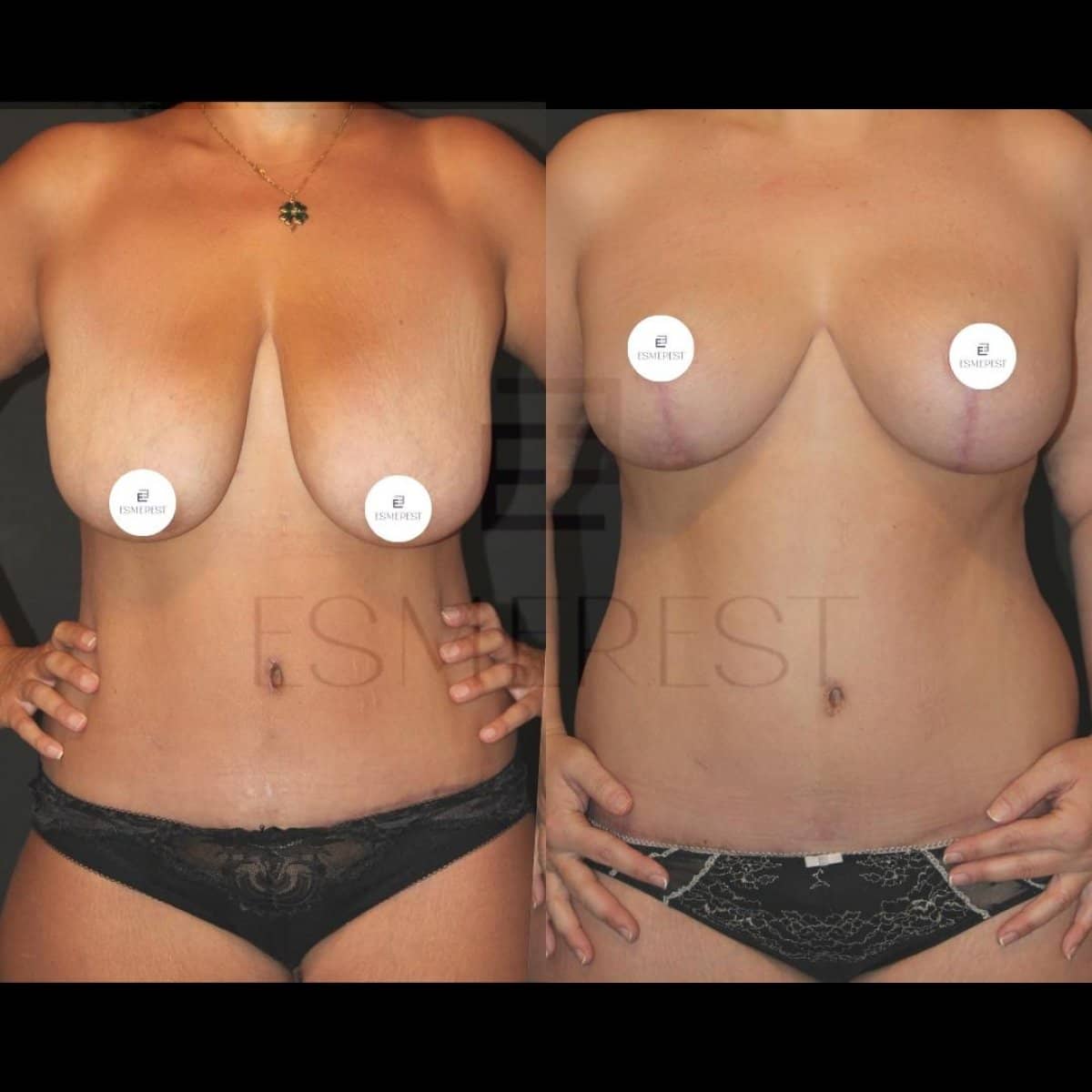 Case 15434 - breast lift
