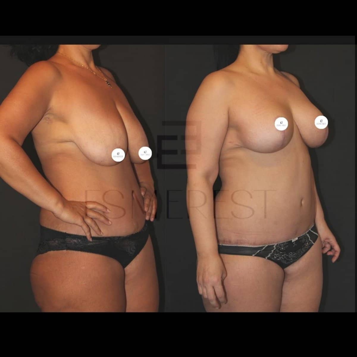 Case 15435 - breast lift