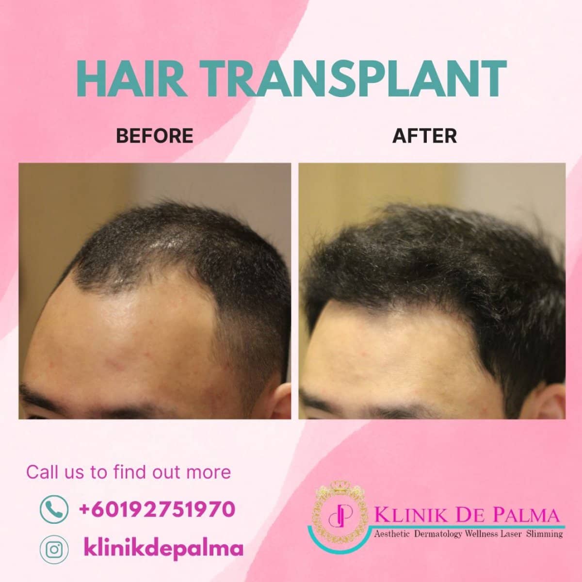 Case 15475 - FUE hair transplant