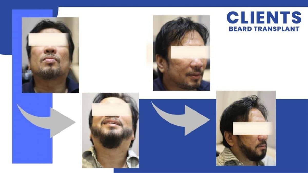 Case 15478 - beard transplant