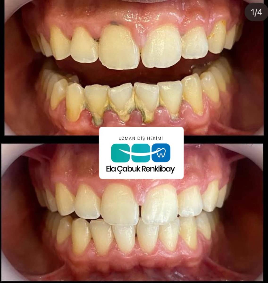 Case 15491 - gingivectomy