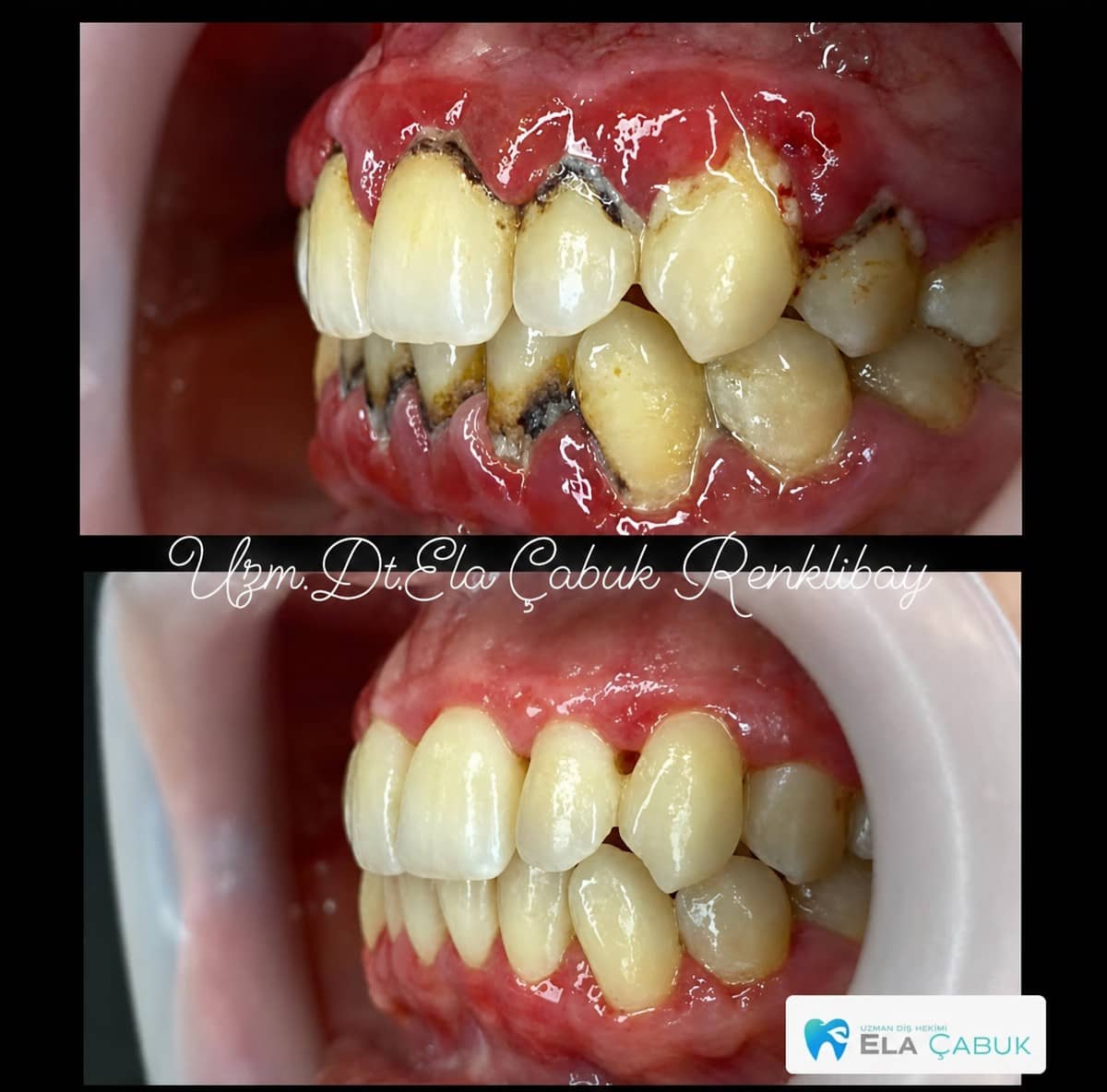 Case 15504 - gum surgery
