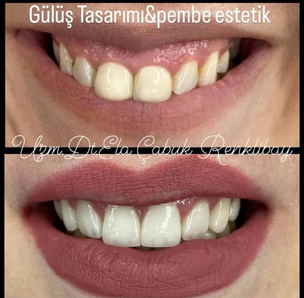 Case 15509 - crown lengthening