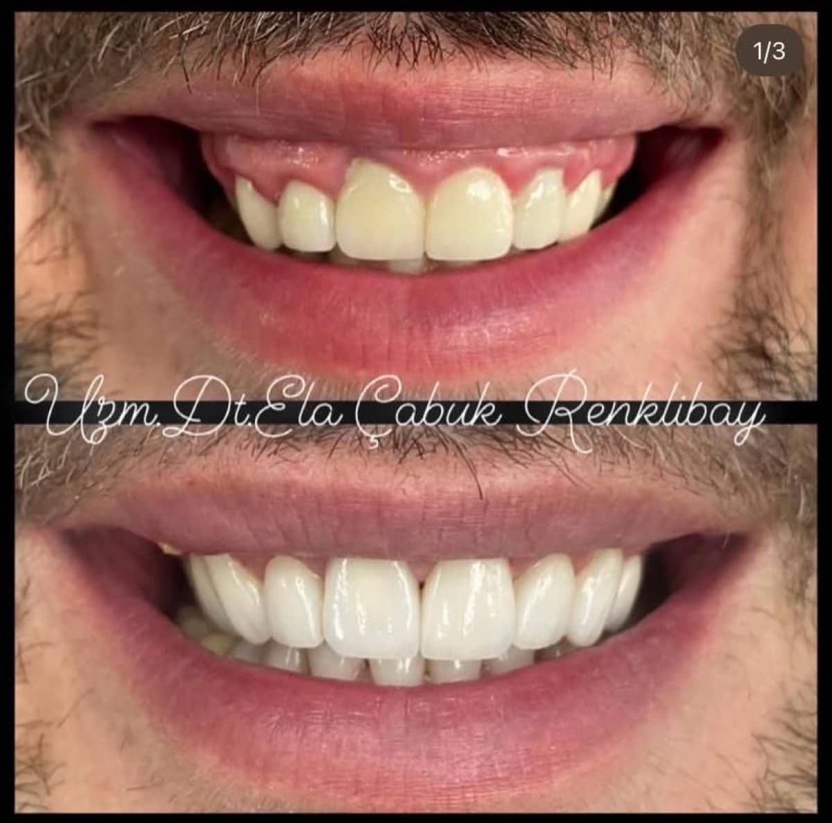 Case 15512 - gingivectomy
