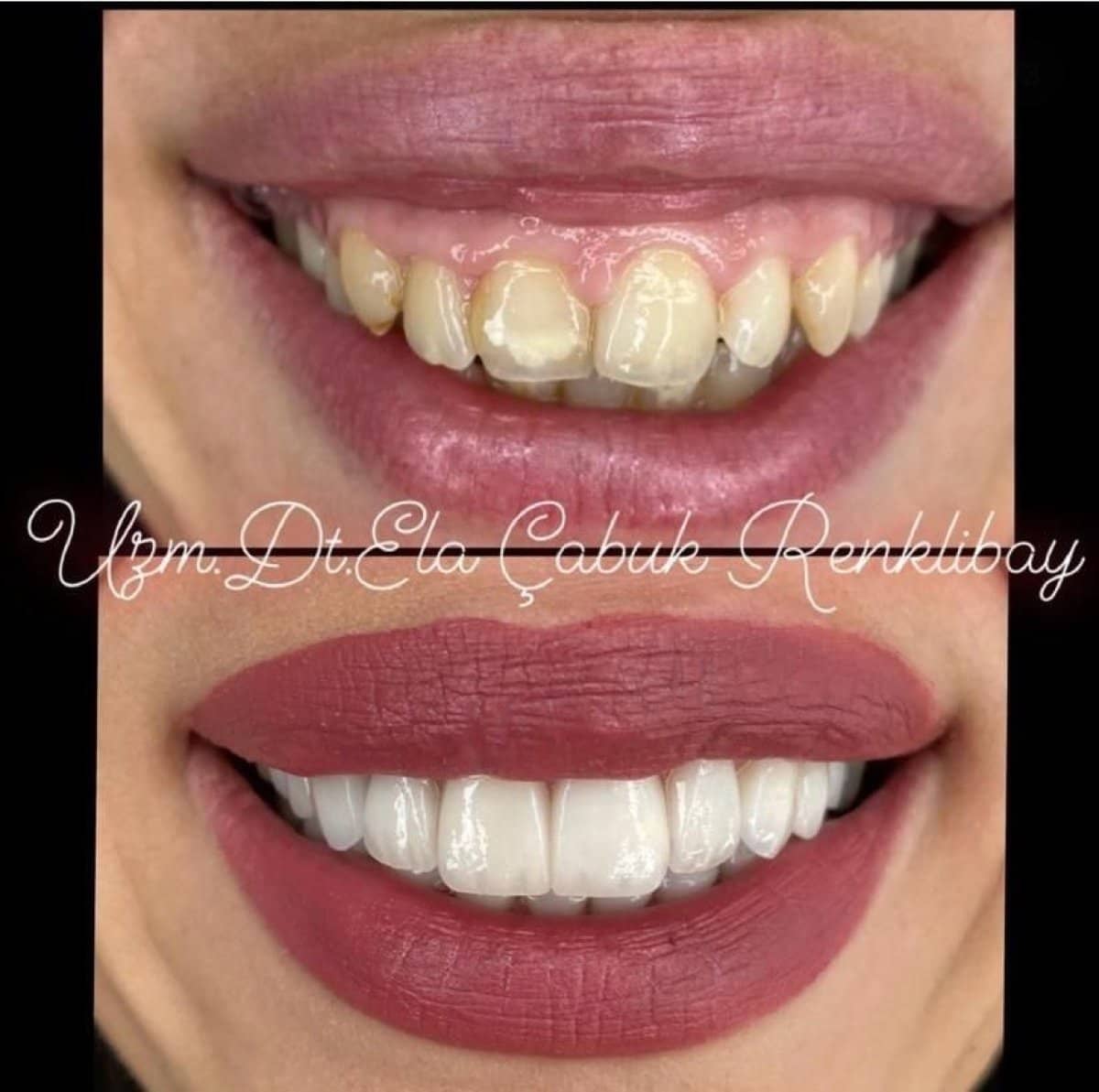 Case 15516 - gingivectomy