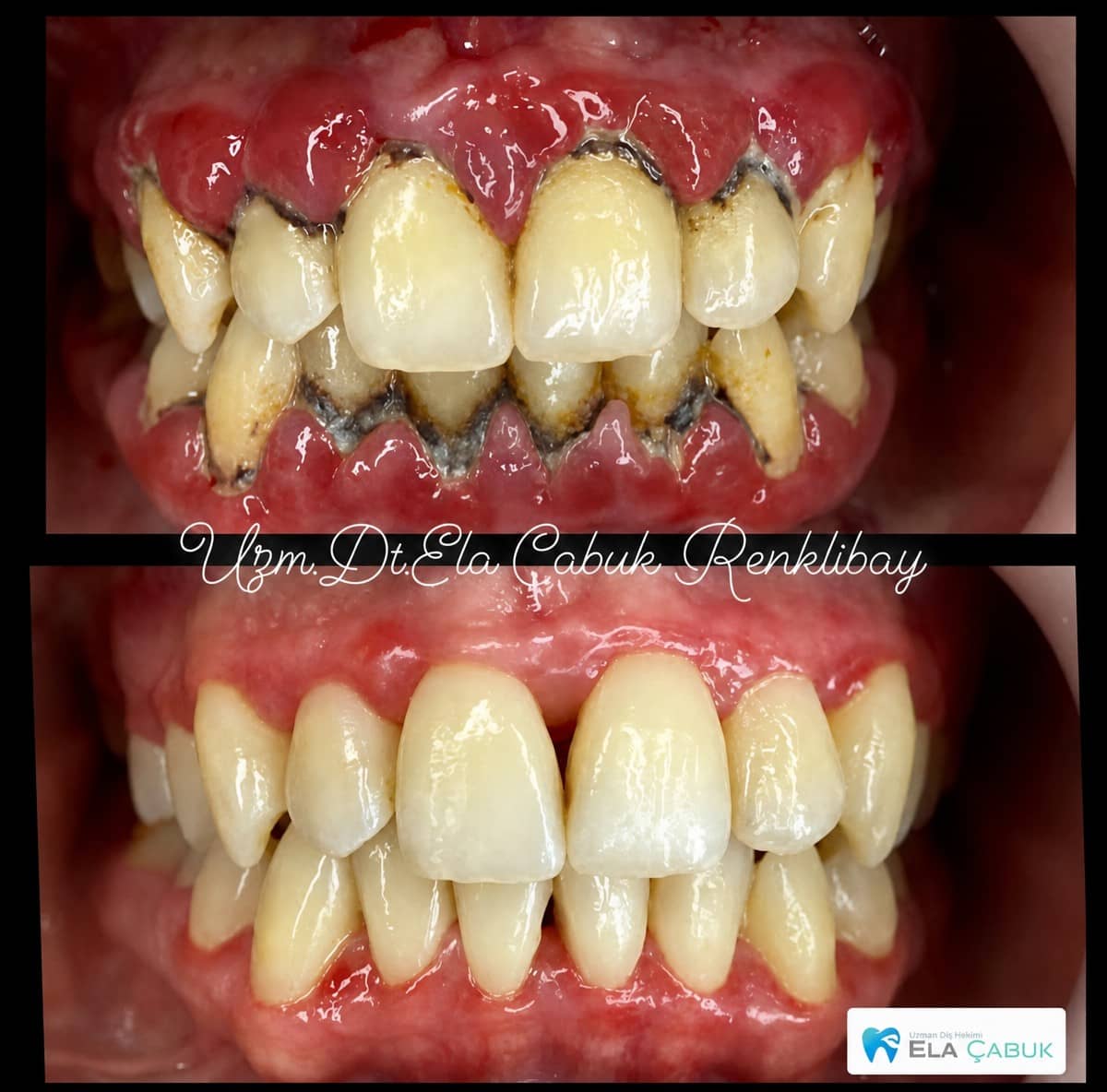 Case 15518 - gum surgery