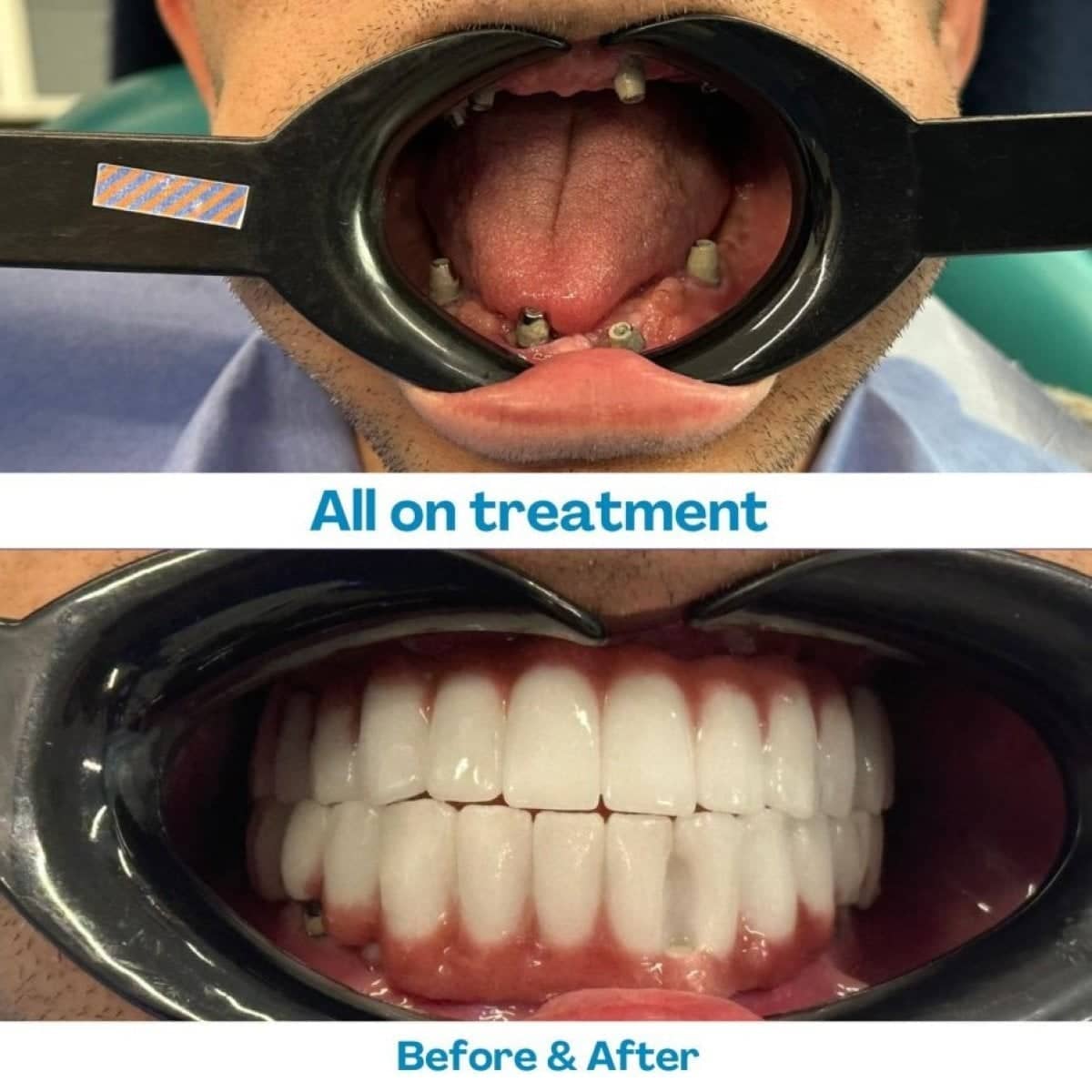 Case 15614 - Zygomatic All-on-4 dental implants