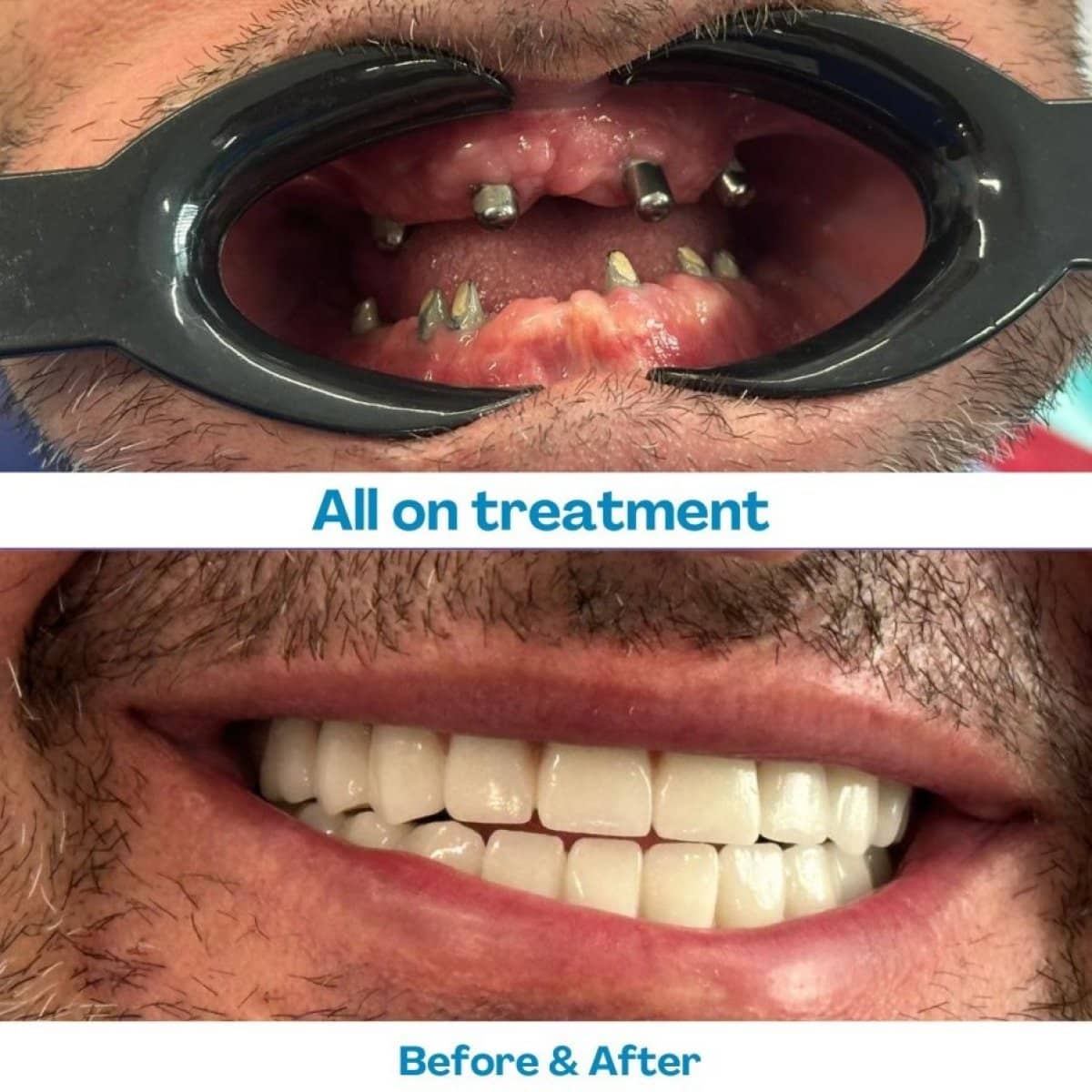 Case 15616 - Zygomatic All-on-4 dental implants