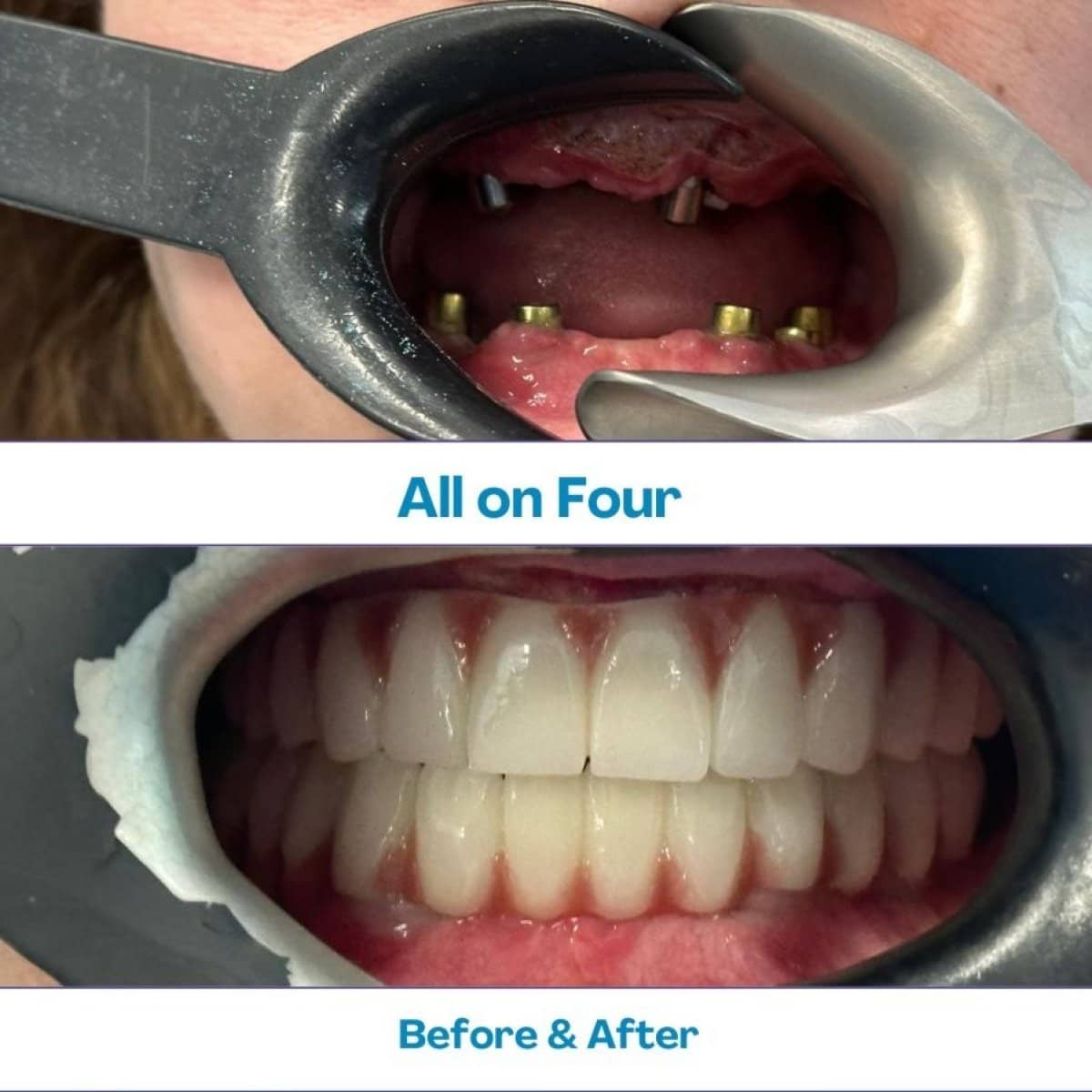 Case 15617 - Zygomatic All-on-4 dental implants
