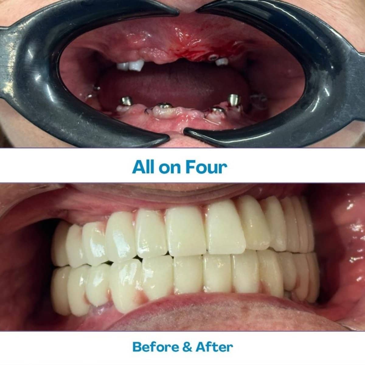 Case 15619 - Zygomatic All-on-4 dental implants