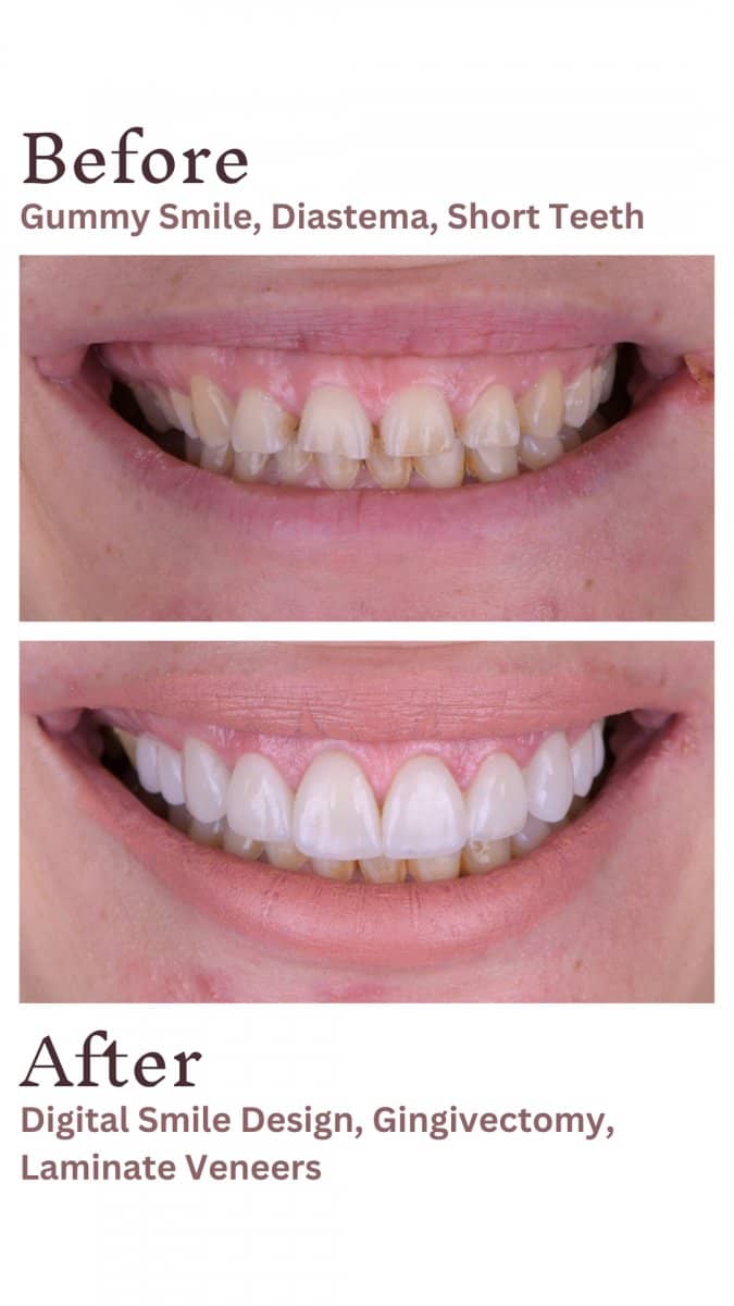 Case 15647 - at UltimaDent Clinic – veneers and gingivectomy