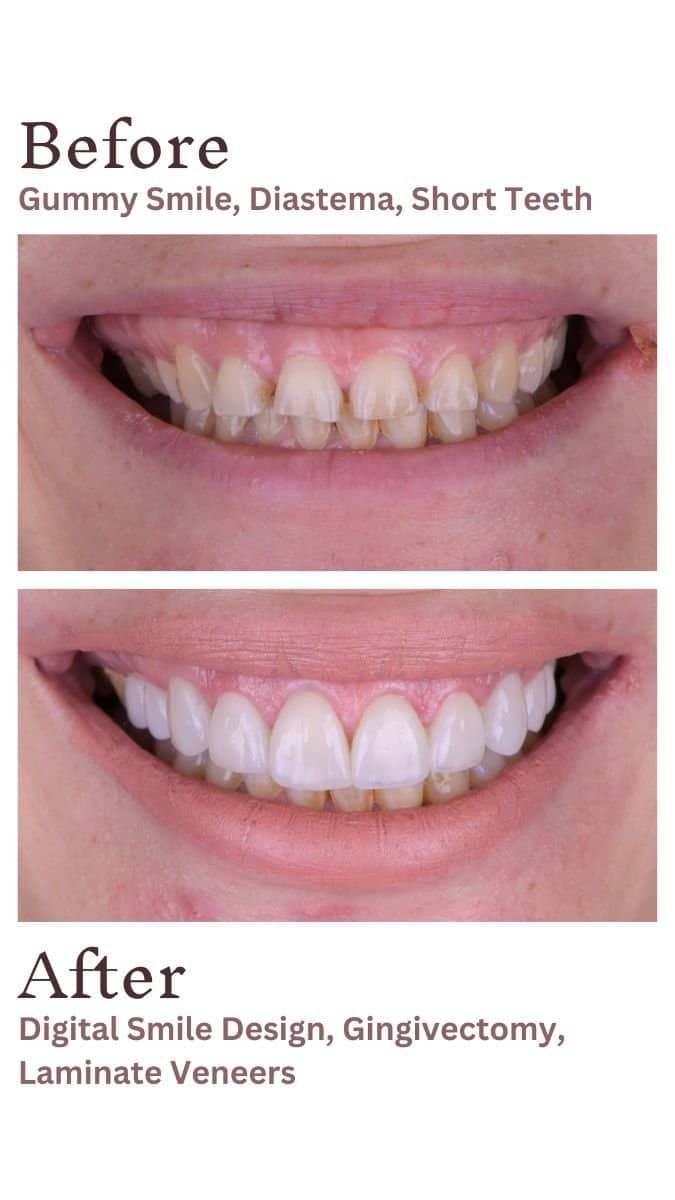 Case 15649 - porcelain veneer and gingivectomy