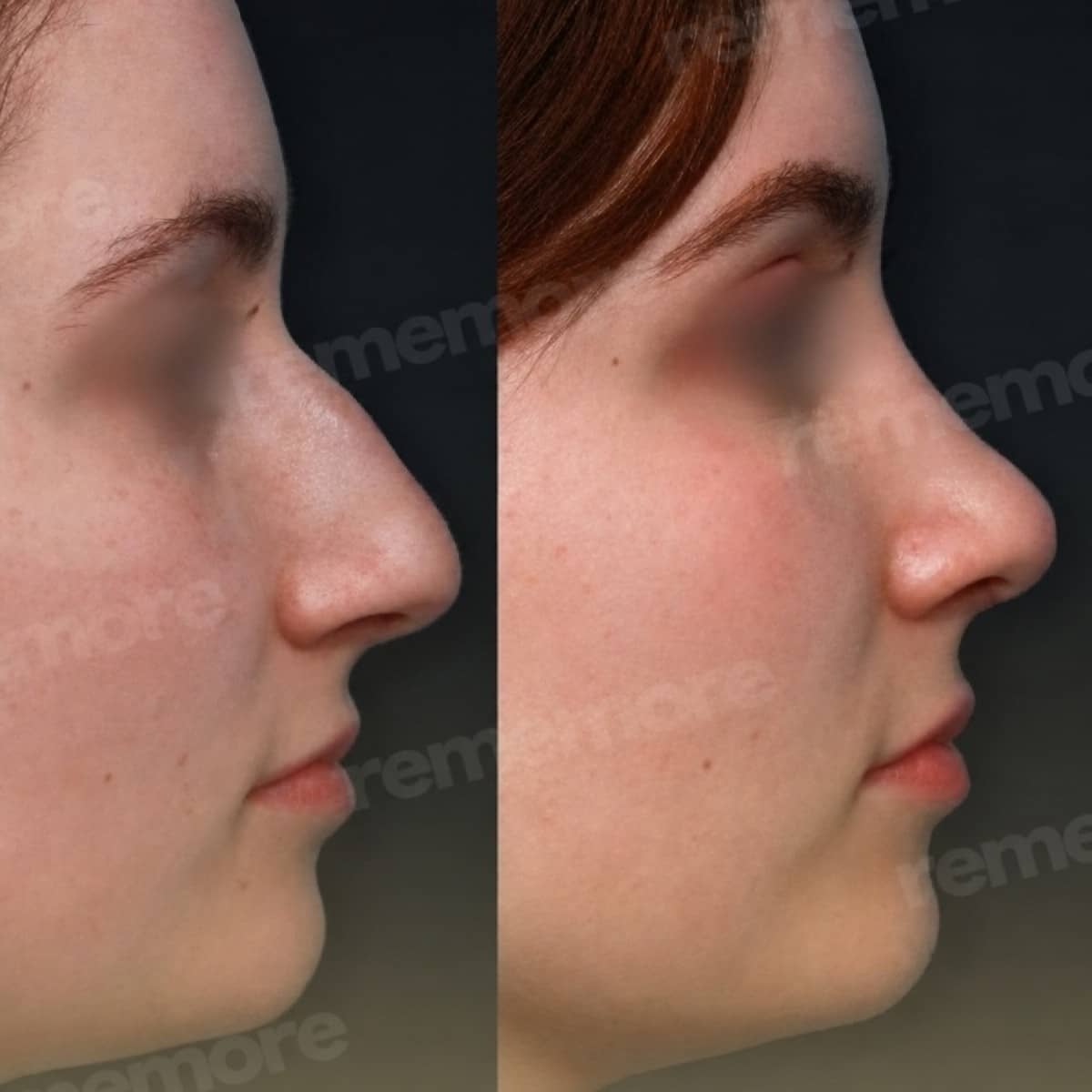 Case 15652 - rhinoplasty
