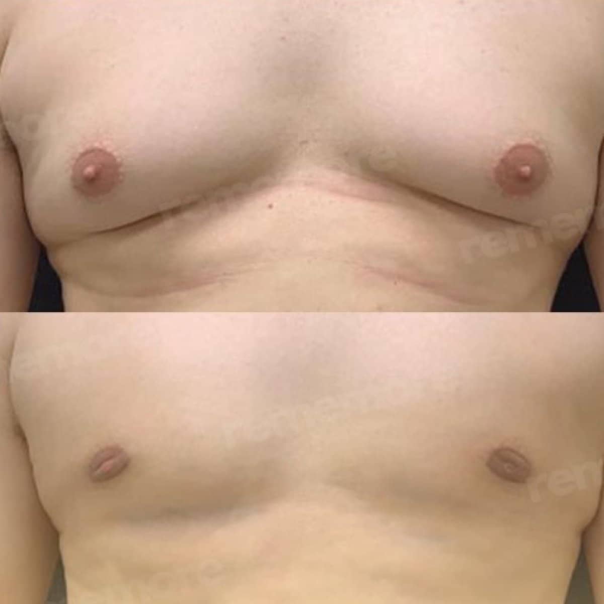 Case 15653 - gynecomastia surgery