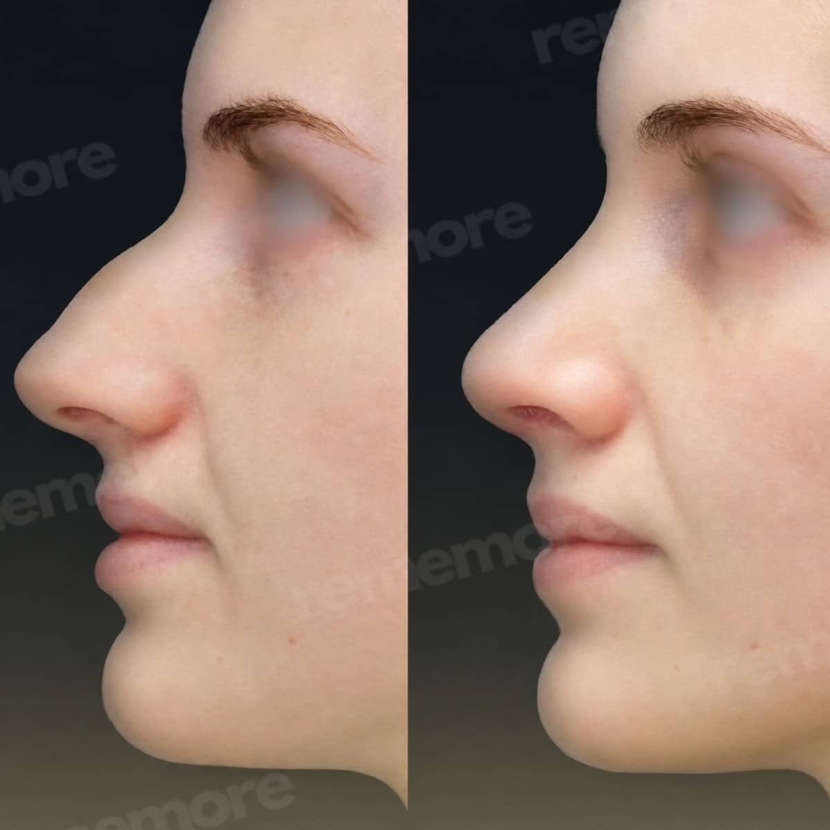 Case 15654 - rhinoplasty