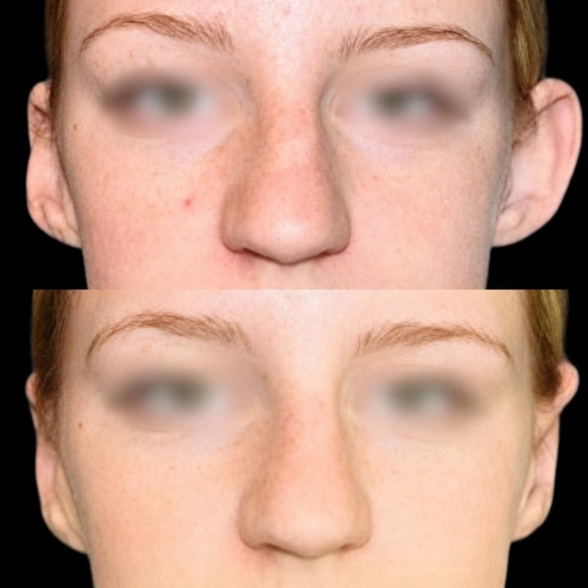 Case 15655 - otoplasty