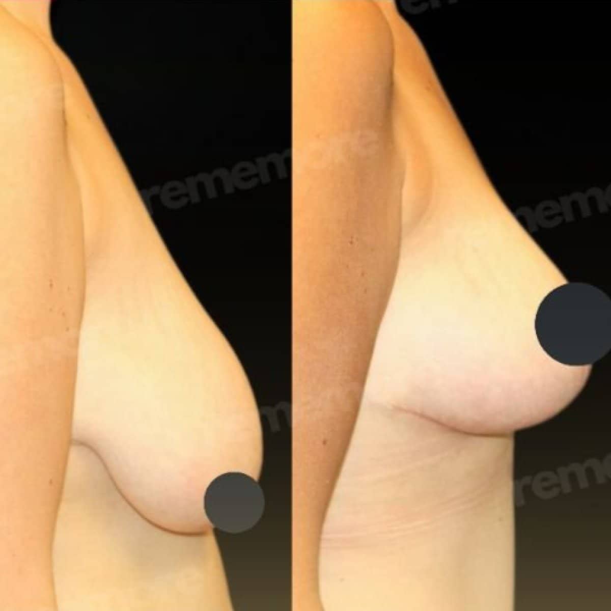 Case 15657 - breast lift
