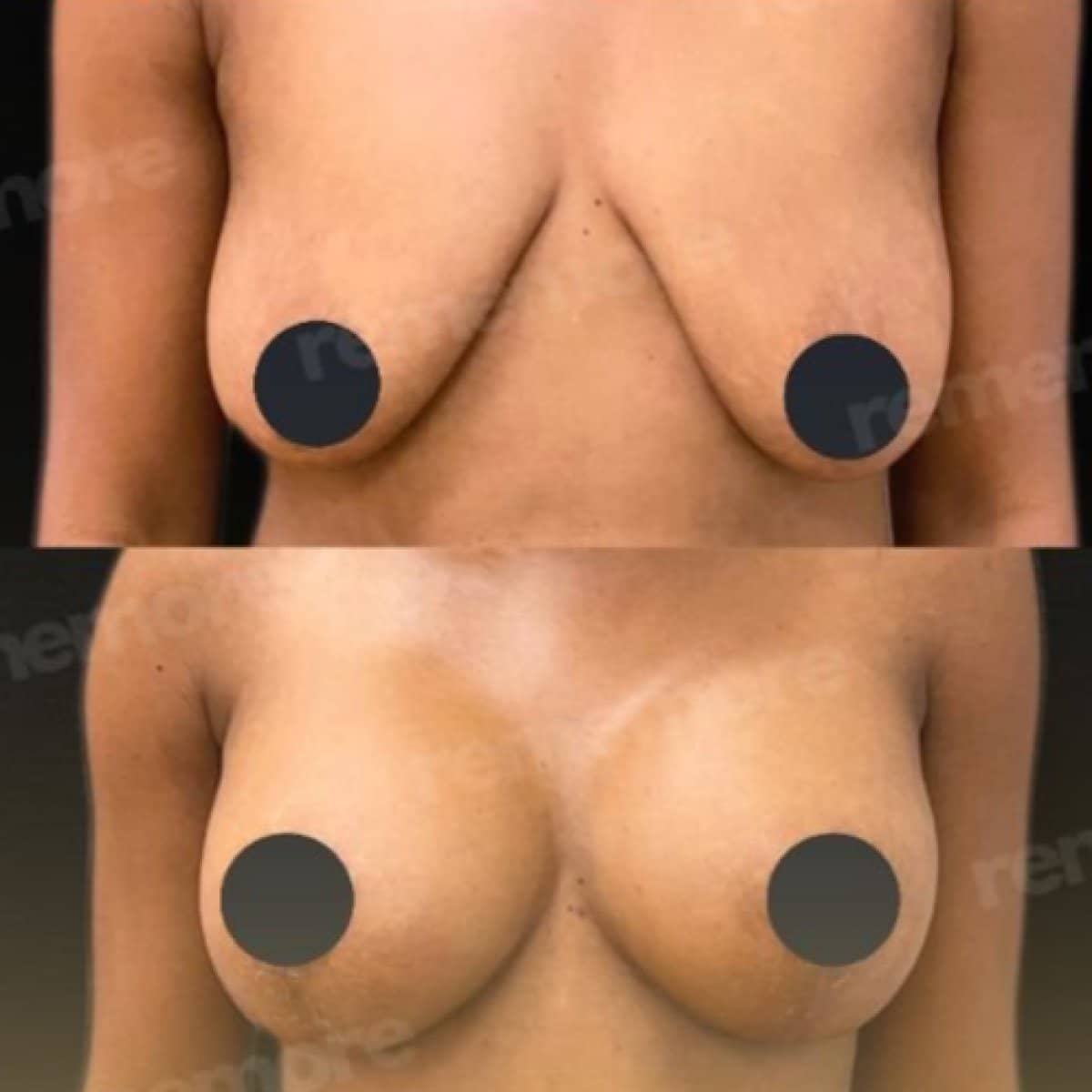 Case 15658 - breast lift