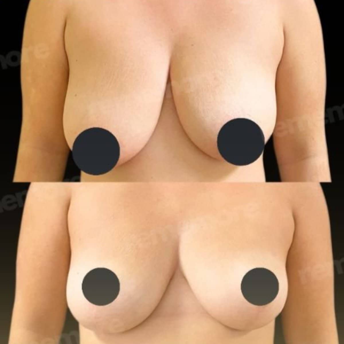 Case 15660 - breast lift