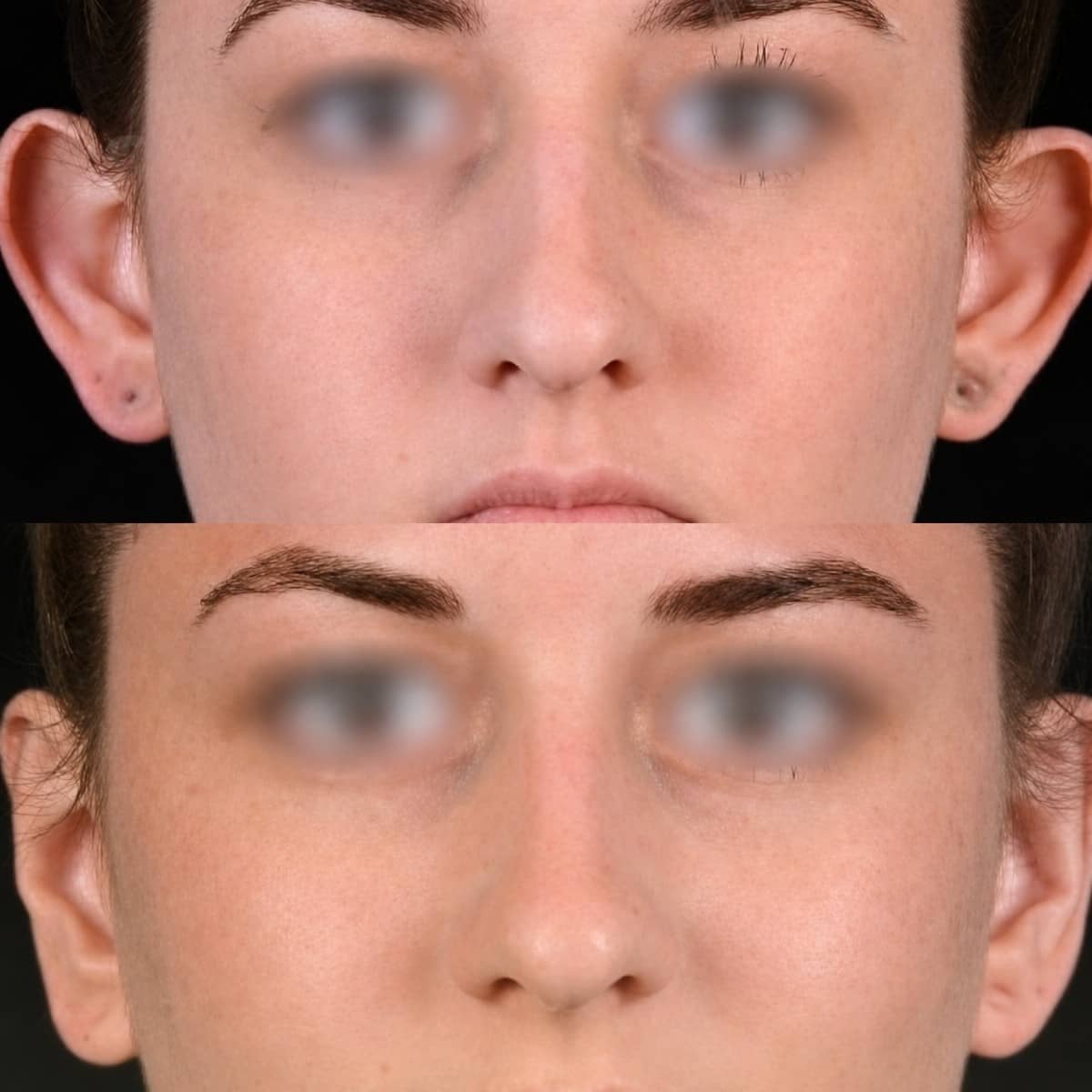 Case 15661 - otoplasty