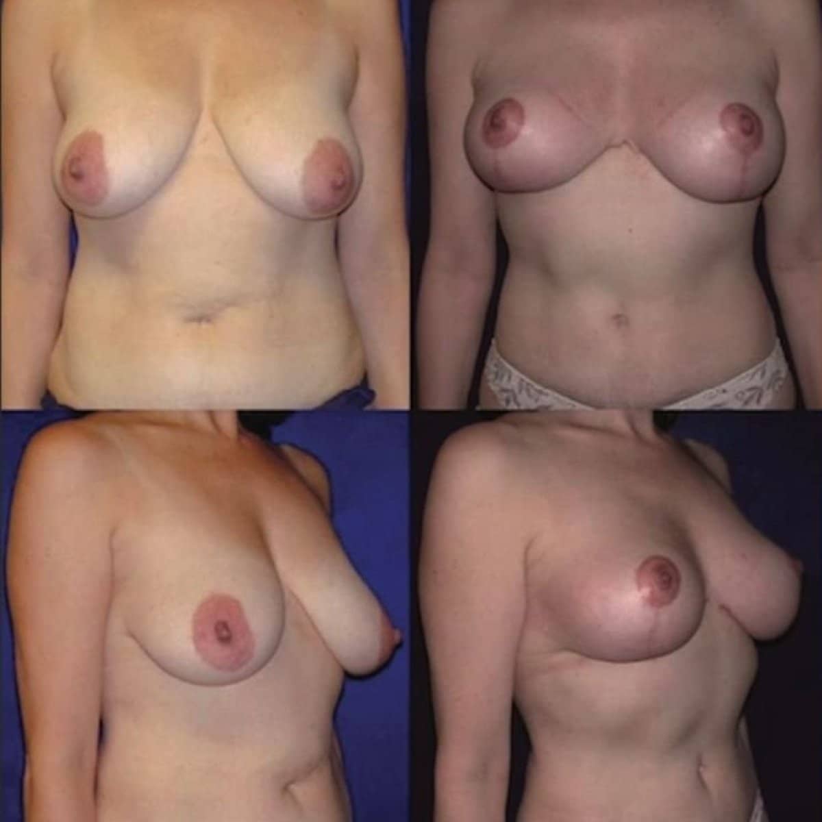 Case 15662 - breast implants with lift