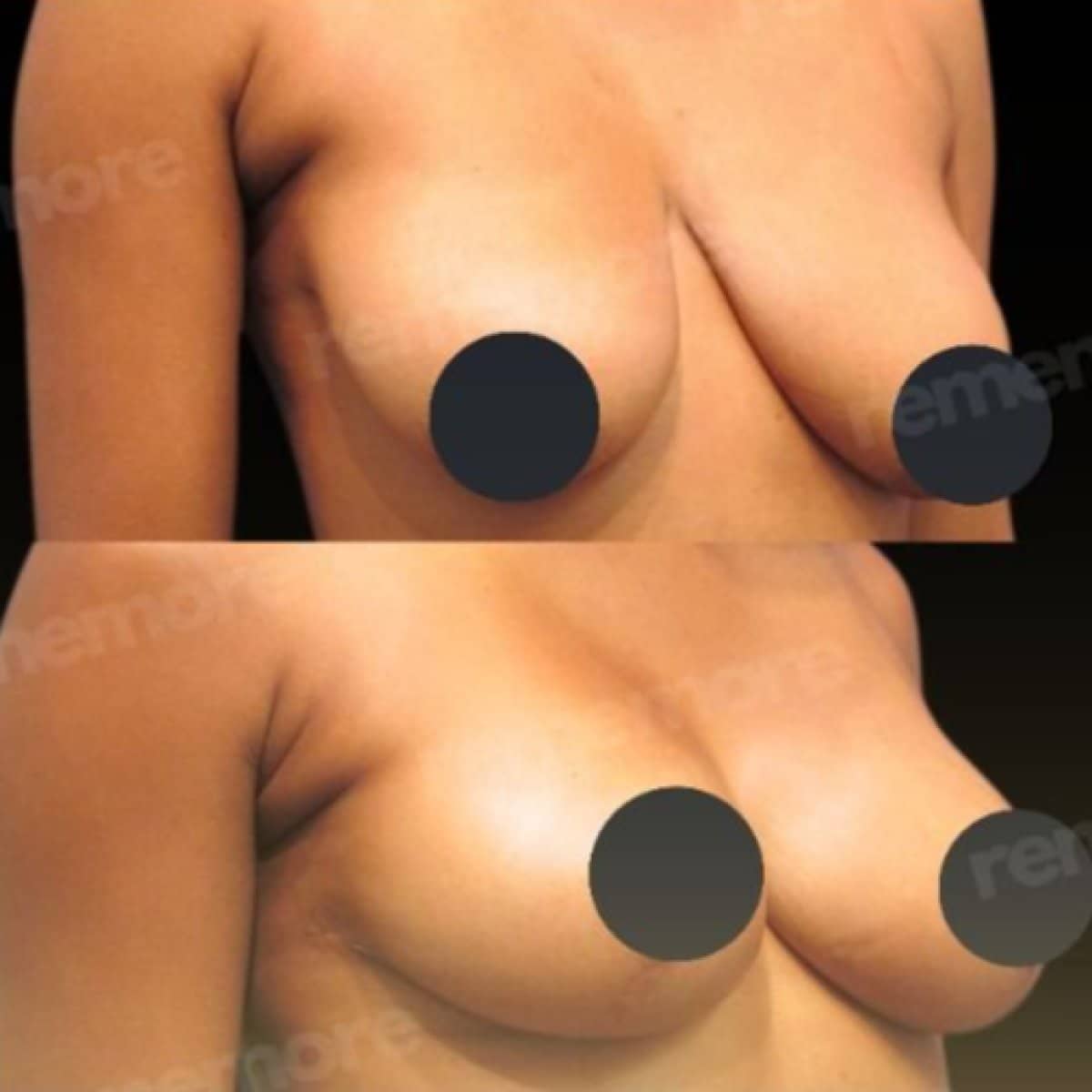 Case 15663 - breast lift