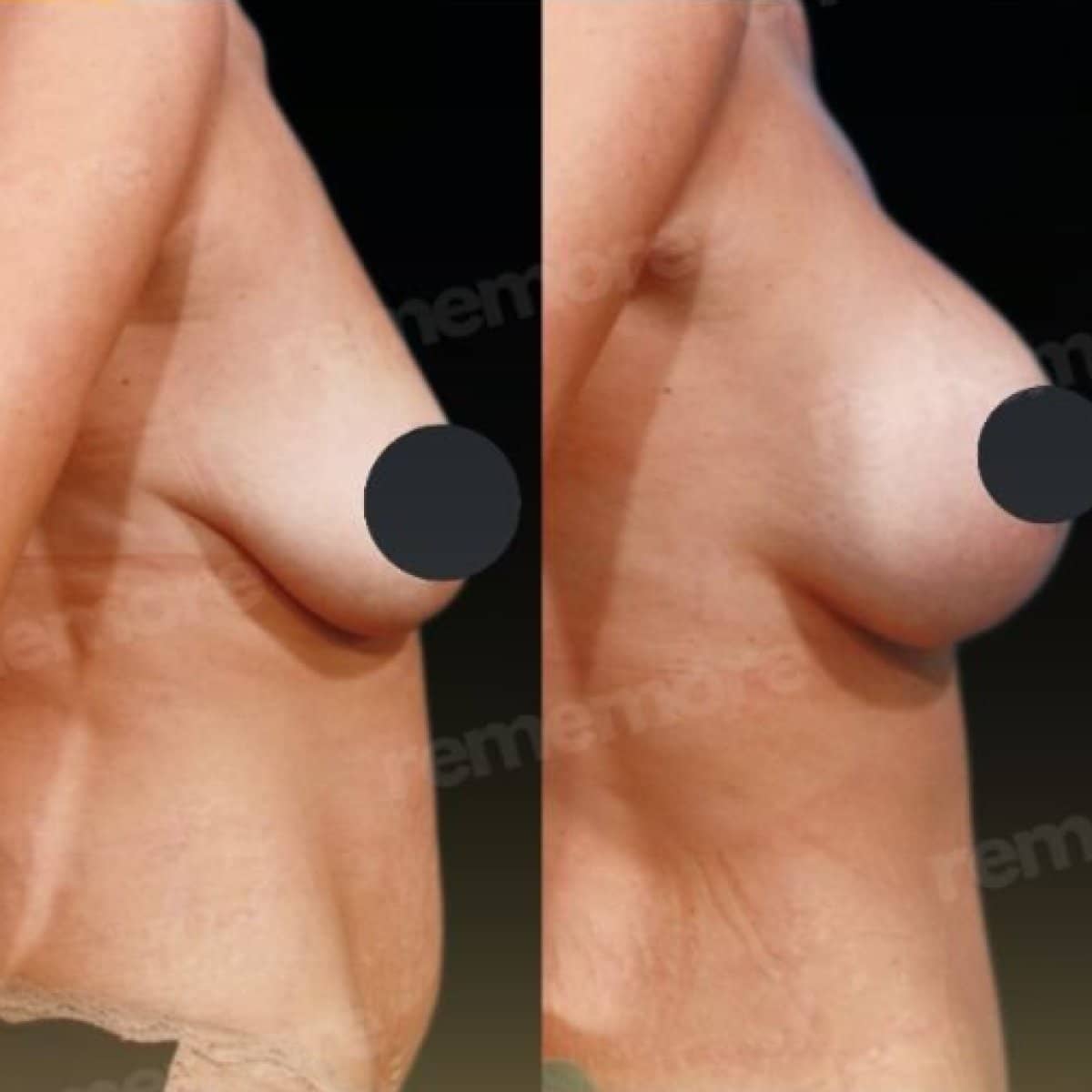 Case 15664 - breast lift