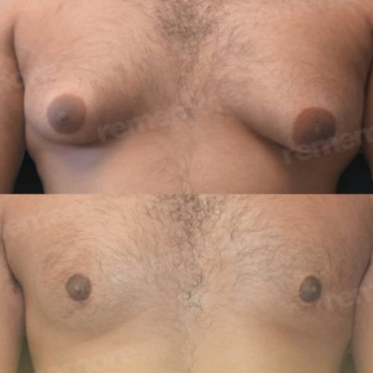 Case 15666 - gynecomastia surgery
