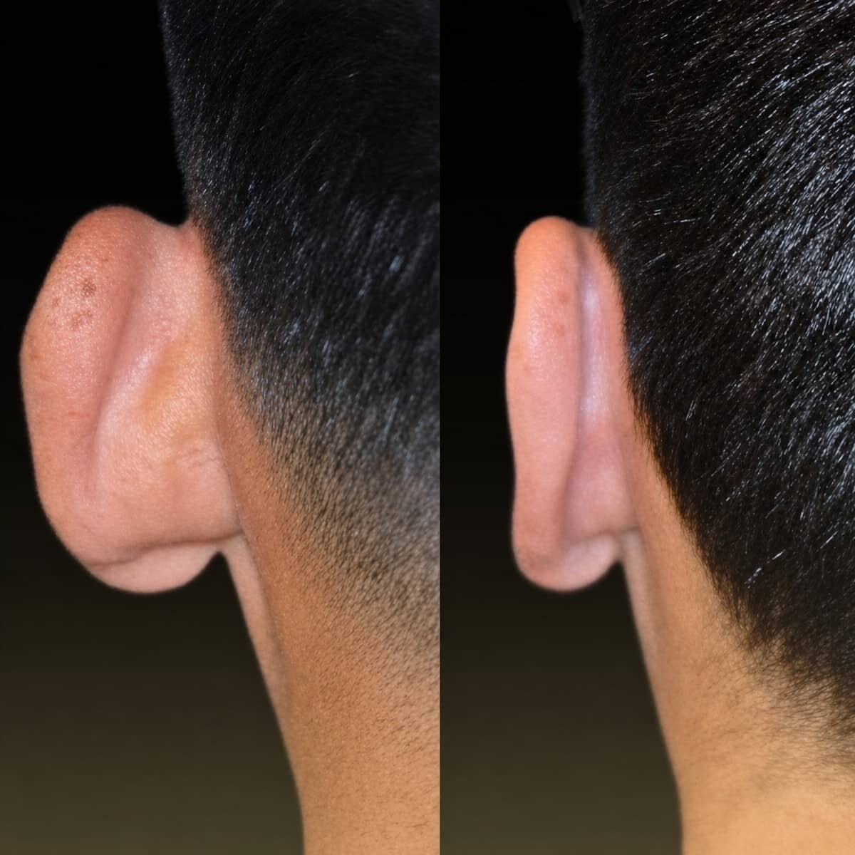 Case 15667 - otoplasty