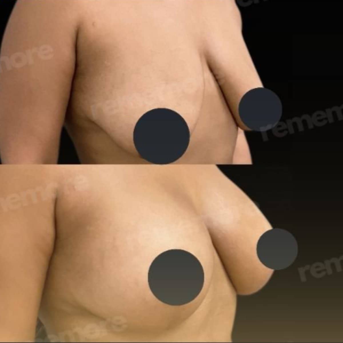 Case 15668 - breast lift