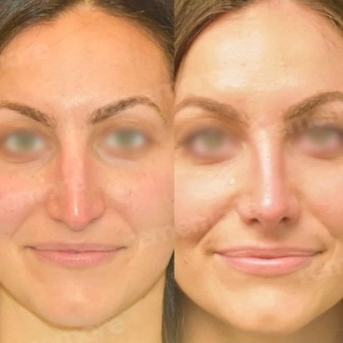 Case 15670 - rhinoplasty