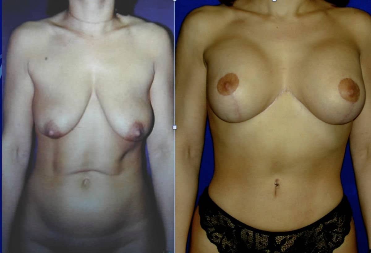 Case 15671 - breast implants with lift