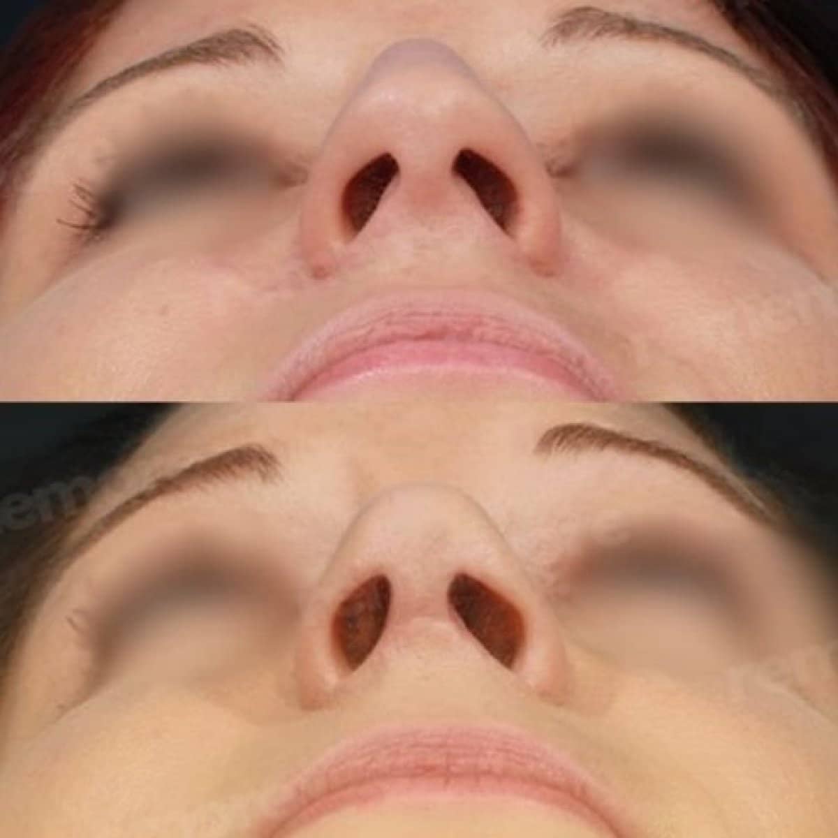 Case 15672 - rhinoplasty